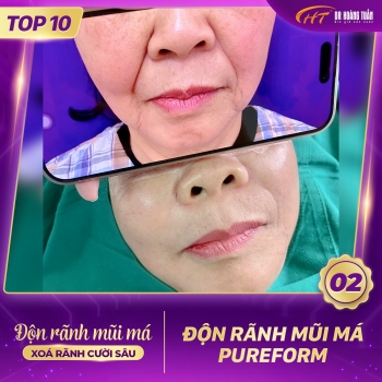 ĐỘN RÃNH MŨI MÁ